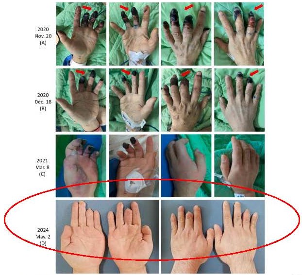 截至目前患者仍然在本院接受中醫治療包括中藥湯劑和中草藥膏劑以用於傷口治療他每天能站立20分鐘從未進行過心臟移植或肢體截肢壞疽的組織自然脫落沒有發生感染01